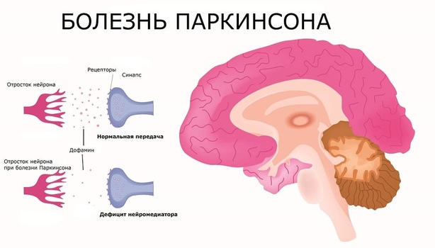 Паркинсон