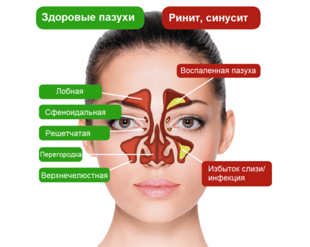 гайморит